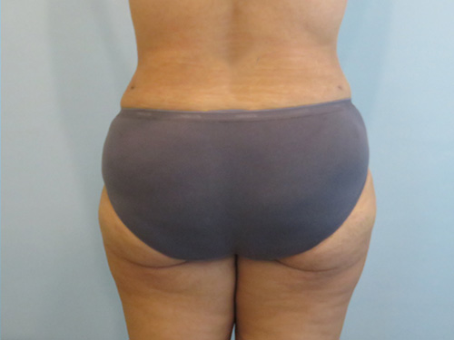 Tummy Tuck | 360 Body Lift Before and After case 1