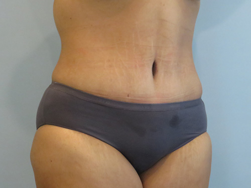 Tummy Tuck | 360 Body Lift Before and After case 1