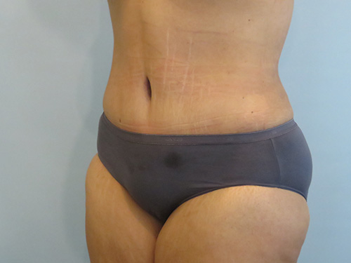 Tummy Tuck | 360 Body Lift Before and After case 1