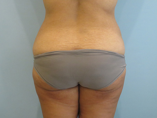 Tummy Tuck | 360 Body Lift Before and After case 1