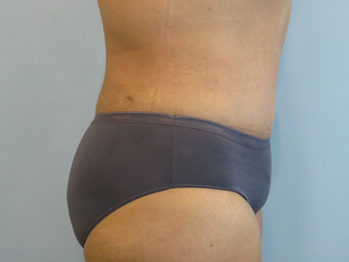 Tummy Tuck | 360 Body Lift Before and After case 1