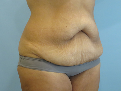 Tummy Tuck | 360 Body Lift Before and After case 1