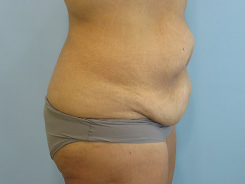Tummy Tuck | 360 Body Lift Before and After case 1