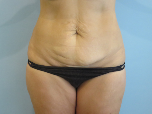 Tummy Tuck | 360 Body Lift Before and After case 2