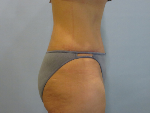 Tummy Tuck | 360 Body Lift Before and After case 2