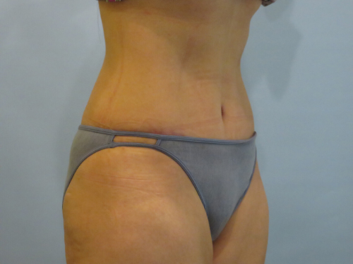Tummy Tuck | 360 Body Lift Before and After case 2