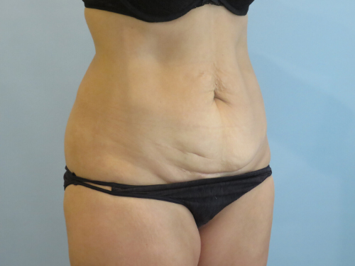 Tummy Tuck | 360 Body Lift Before and After case 2