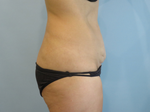Tummy Tuck | 360 Body Lift Before and After case 2