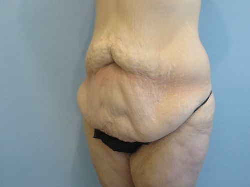 Tummy Tuck | 360 Body Lift Before and After case 3