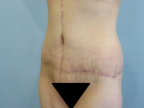 Tummy Tuck | 360 Body Lift Before and After case 3