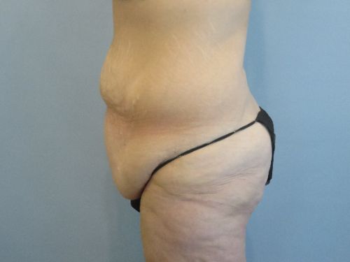 Tummy Tuck | 360 Body Lift Before and After case 3