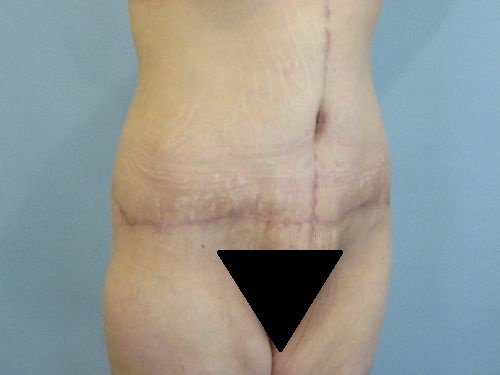 Tummy Tuck | 360 Body Lift Before and After case 3