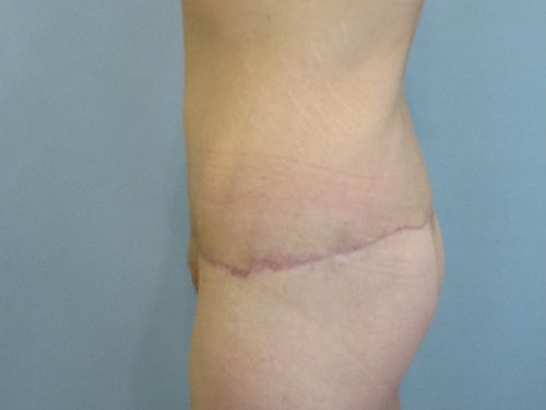 Tummy Tuck | 360 Body Lift Before and After case 3