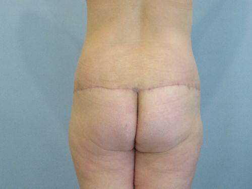 Tummy Tuck | 360 Body Lift Before and After case 3
