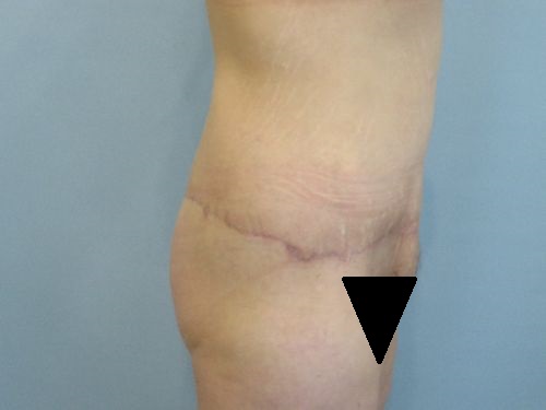 Tummy Tuck | 360 Body Lift Before and After case 3