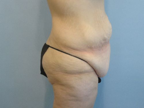 Tummy Tuck | 360 Body Lift Before and After case 3