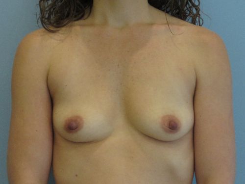 Breast Augmentation Before & After case 1