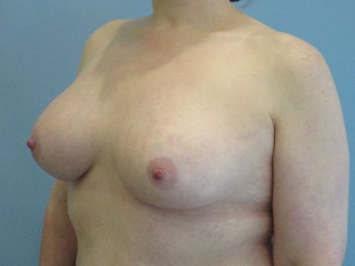 Breast Augmentation Before & After case 9
