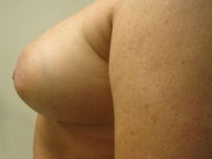 Breast Augmentation Before and After case 15