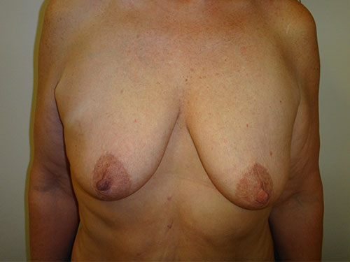 Breast Lift Before & After case 3