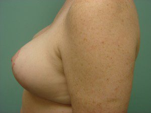Breast Lift Before and After case 4