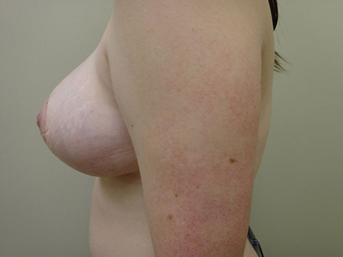 Breast Reduction Before & After case 2