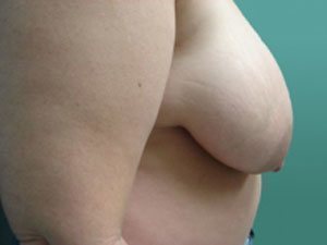 Breast Reduction Before & After case 3
