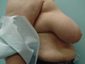 Breast Reduction Before and After Case 5