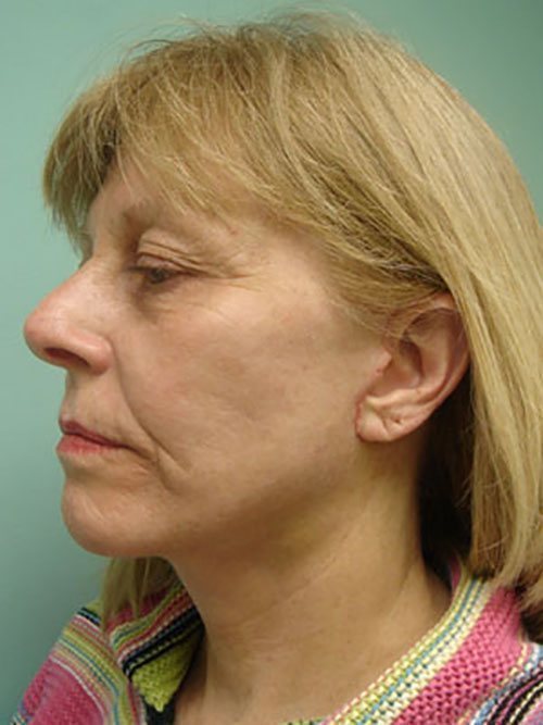 Facelift | Neck Lift Before & After case 3