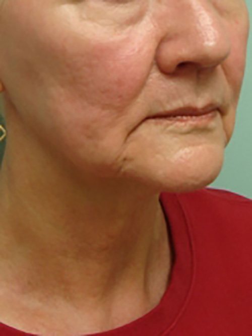 Facelift | Neck Lift Before and After case 1