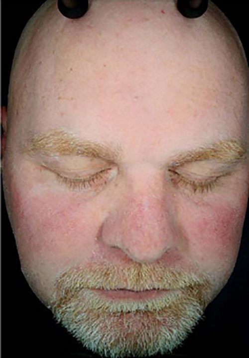 Facial Rejuvenation Before & After Case 2