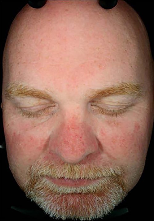 Facial Rejuvenation Before & After Case 2