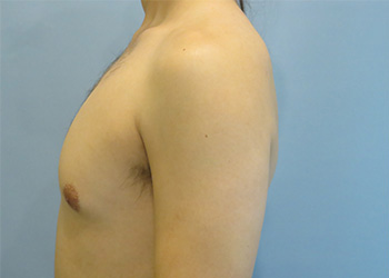 Gynecomastia Before & After