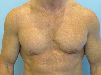 Gynecomastia Before & After case 10