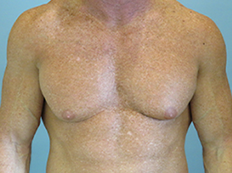 Gynecomastia Before & After case 10