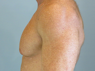 Gynecomastia Before & After case 10