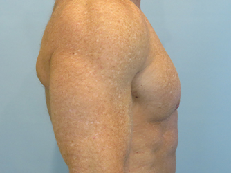 Gynecomastia Before & After case 10