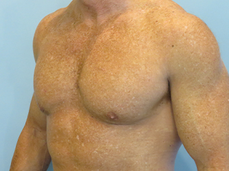 Gynecomastia Before & After case 10