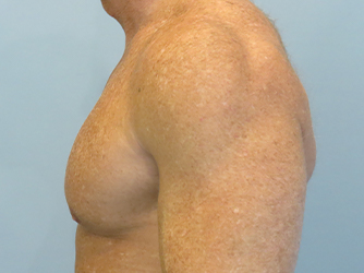 Gynecomastia Before & After case 10