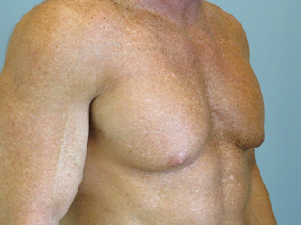 Gynecomastia Before & After case 10