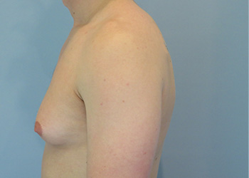 Gynecomastia Before & After case 1