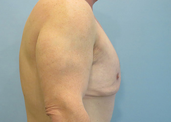 Gynecomastia Before & After case 2