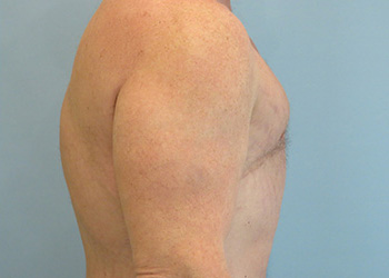 Gynecomastia Before & After case 2