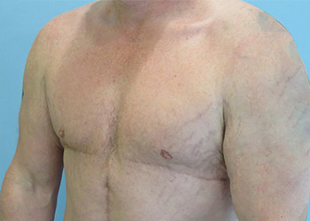Gynecomastia Before & After case 2