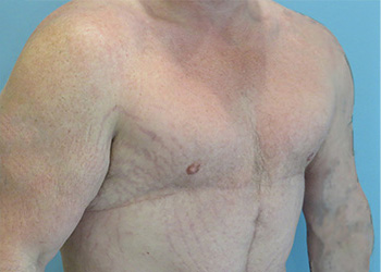 Gynecomastia Before & After case 2