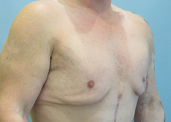 Gynecomastia Before & After case 2