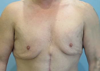 Gynecomastia Before & After case 2