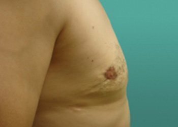 Gynecomastia Before & After case 3