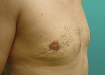 Gynecomastia Before & After case 3