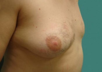 Gynecomastia Before & After case 3